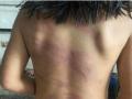 Vụ bé gái bị bạo hành chi chít vết thương, Chủ tịch Bình Phước chỉ đạo khẩn