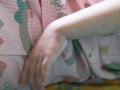 Trẻ mắc bệnh sởi cần được chăm sóc như thế nào?