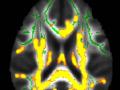 Mỡ bụng cảnh báo bệnh Alzheimer?