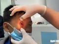 Đã xác định được tác nhân gây bệnh đau mắt đỏ ở TP.HCM
