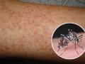 Gia tăng bệnh nhân sốt xuất huyết chuyển nặng, có dấu hiệu phá vỡ quy luật