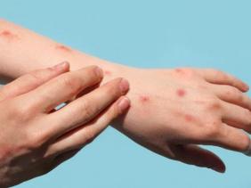 WHO thông báo tên gọi mới của bệnh đậu mùa khỉ
