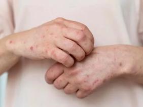 Ghi nhận 2 ca mắc đậu mùa khỉ, Bộ Y tế đề nghị xác định nguồn lây