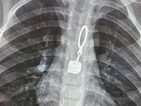 Đưa con đi khám vì đau họng, bác sĩ phát hiện khóa áo nằm trong thực quản