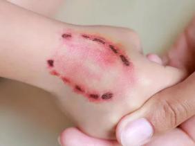 Bộ Y tế cảnh báo nguy cơ bùng phát bệnh dại