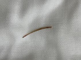 Thủng ruột non do vô tình nuốt phải xương cá tai tượng