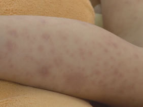 8 bệnh viện tuyến cuối điều trị sốt xuất huyết tại TP.HCM