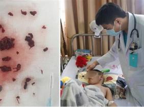 Cảnh báo đột quỵ ở trẻ em