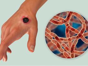 Bộ Y tế cập nhật thông tin mới nhất về tình hình dịch bệnh than trên người