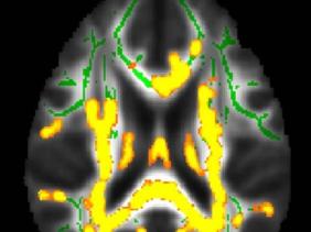 Mỡ bụng cảnh báo bệnh Alzheimer?
