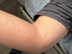 Hà Nội phát hiện thêm nhiều ổ dịch sốt xuất huyết: Chỉ số muỗi sau xử lý vẫn nguy hiểm