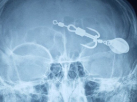 Đi xem câu cá, bé trai bị lưỡi câu móc vào mắt