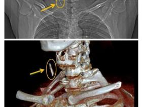 Người đàn ông bị chiếc đinh rỉ cắm sâu trong cổ suốt 15 năm