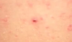 Ba người tử vong do virus Hanta, Bộ Y tế khuyến cáo 5 biện pháp phòng bệnh
