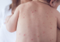 42 ca nghi mắc bệnh sởi, Bộ Y tế đề nghị rà soát việc tiêm chủng